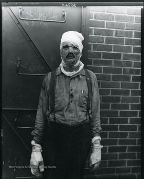 Severly burned man with his face and hands bandaged.